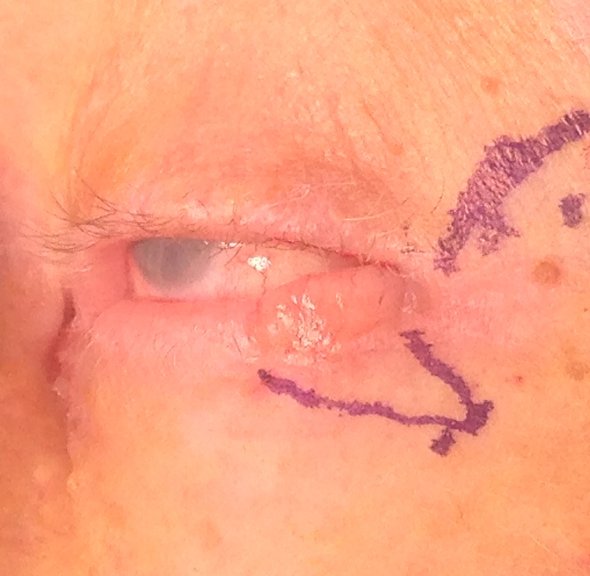 Eyelid Cancer