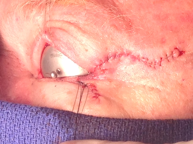 Repair of Eyelid